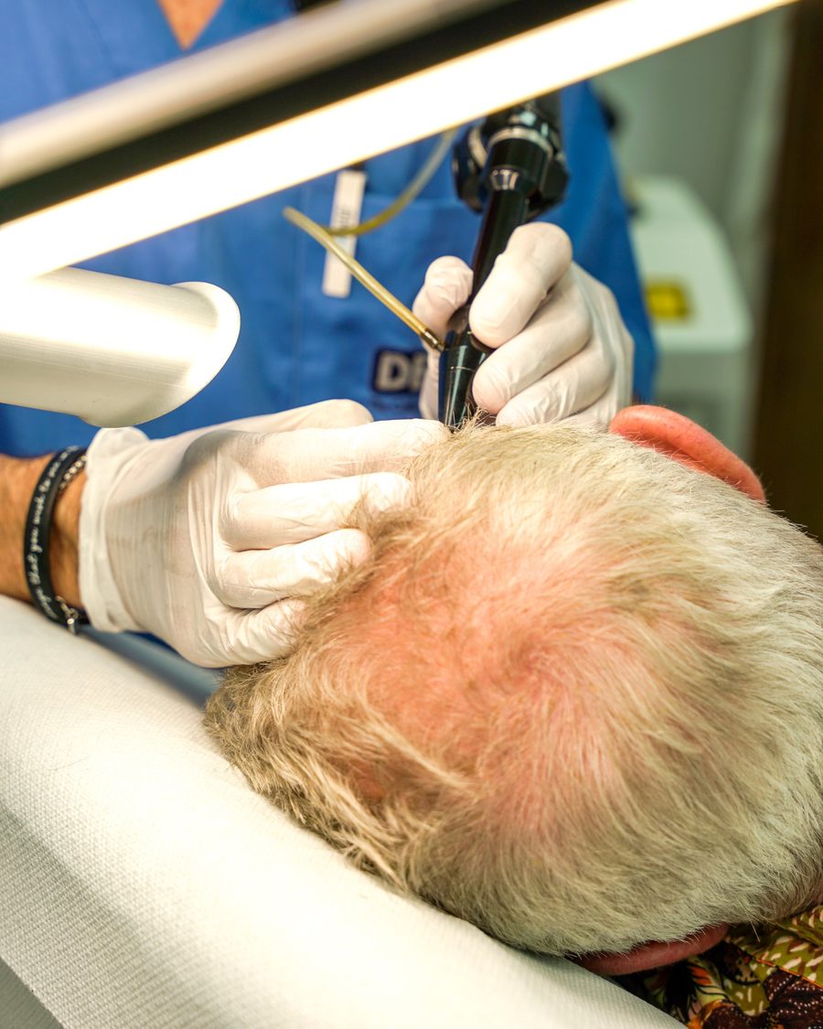 Trattamento laser sul cuoio capelluto