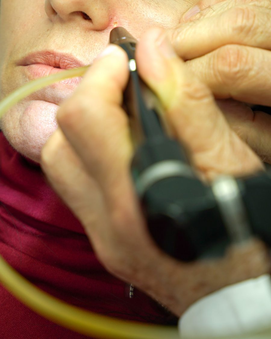 Trattamento laser vicino al naso di una paziente